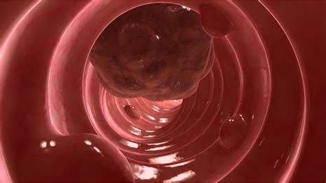 Colorectal Cancer Stool