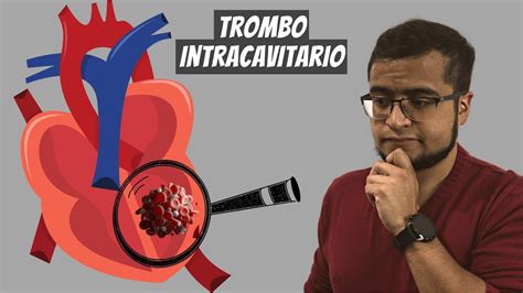 Trombo Intracavitario Perlascl Nicas Youtube