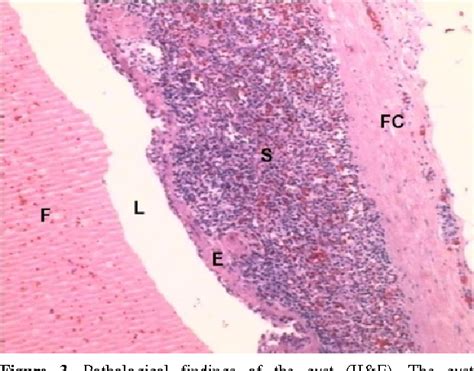 Figure 1 From An Epithelial Splenic Cyst In An Intrapancreatic Accessory Spleen A Case Report