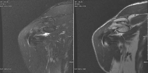 Coronal view of Rt. Shoulder MRI (SLAP lesion). | Download Scientific ...