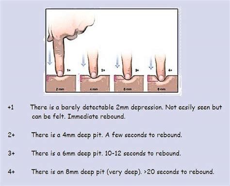 MedicTests.com - Pitting Edema Grading