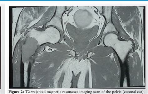 Figure From Rare Case Of A Solitary Bone Plasmacytoma Of The Proximal