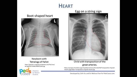 Approach To Pediatric Chest X Rays Youtube