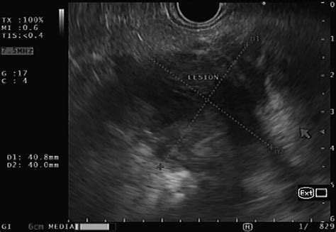 Endoscopic Ultrasonography Image With A Multiseptated Predominantly