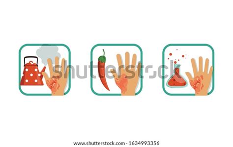 Types Burns Set Thermal Chemical Hot เวกเตอร์สต็อก ปลอดค่าลิขสิทธิ์
