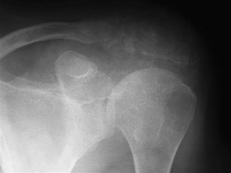 Aggressive Chondroblastoma Of The Acromion In A Forty One Year Old