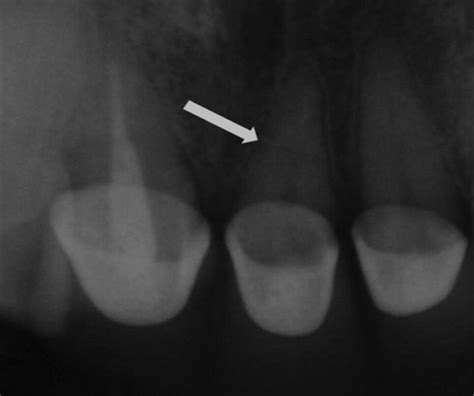 Radiographic View Of Root Fracture Of The Maxillary Left Central Incisor Download Scientific