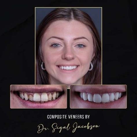 Composite Veneers In Melbourne Dental Veneers Cost Melbourne