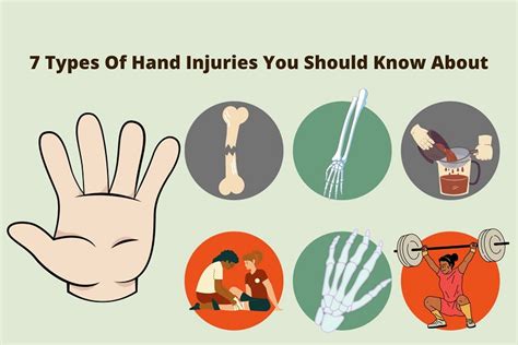 7 Types Of Hand Injuries You Should Know About Mahevash Muses