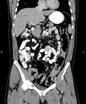 Ulcerative Colitis Radiology Case Radiopaedia Org