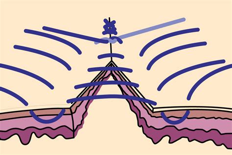 Common Suture Patterns And Suture Techniques Endogynecology