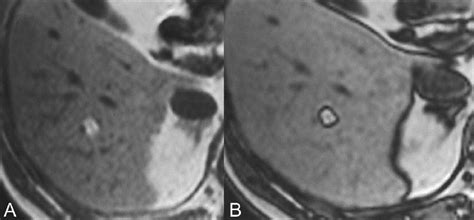 Hepatic Lipomatous Lesion A Axial In Phase T1 Weighted Gre Image Download Scientific Diagram