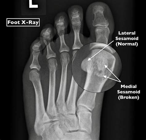 Could Your Nagging Foot Pain Be Sesamoiditis
