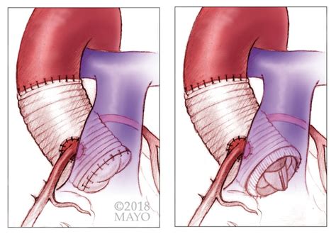 Marfan Syndrome Is A Genetic Disorder Associated With _____ Tissue ...