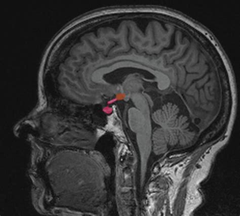 Brain Mri Pituitary And Hypothalamus Photograph By Steven Needell Pixels