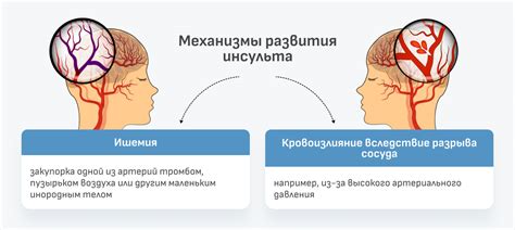 Восстановление после инсульта: речь, зрение, память, моторика и другие ...