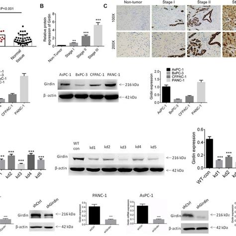 Expression Of Girdin In Pancreatic Cancer Tissues And Cell Lines A