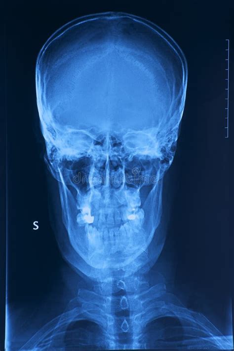 skull  ray image stock photo image  body research