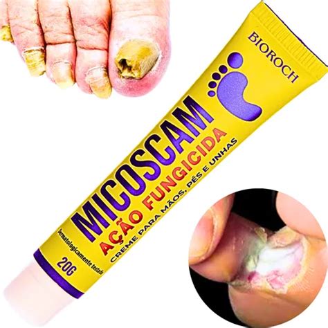 Melhor Pomada Para Pé De Atleta - Frieira Pé De Atleta Micose Nos Pés E Mãos Pomada/creme | MercadoLivre