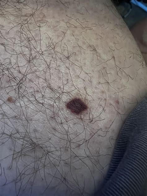 Weird Spot on Thigh : r/DermatologyQuestions