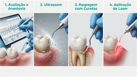 O Que É Raspagem No Dente - Raspagem Periodontal: Como Funciona, Preço e Recuperação