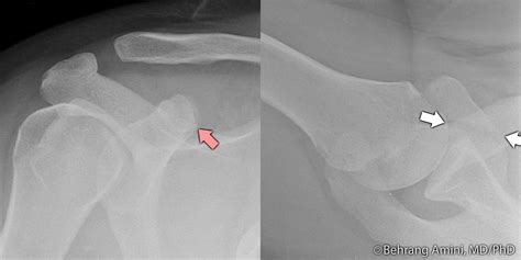 Roentgen Ray Reader Coracoid Fractures