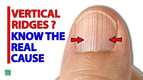 Did You Know The Real Cause Of Vertical Ridges On Your Nails Youtube