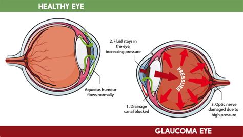 cbd  glaucoma    affect eye pressure
