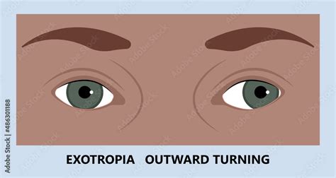 Diplopia Double Vision Test Exam Brain Nerve Dry Eye Palsy Gravis