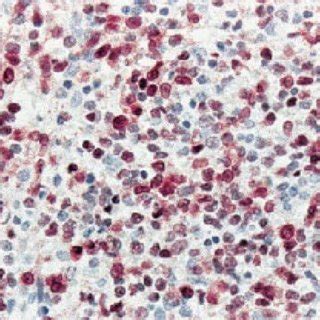 Cd A Positive Blasts In The Bone Marrow Biopsy From A Patient With