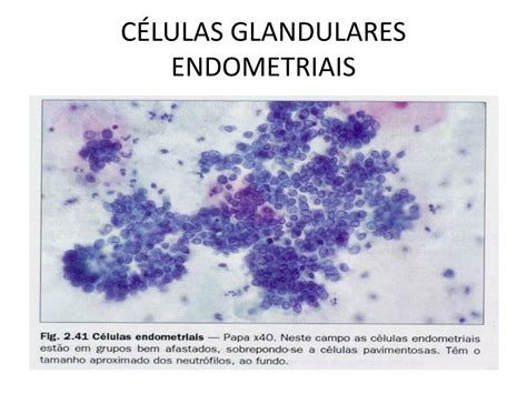 Elementos Da Zona De Transformação Células Glandulares Endocervicais Presentes - PPT - ELEMENTOS CELULARES EPITELIAIS PRESENTES NO ESFREGAÇO PowerPoint ...