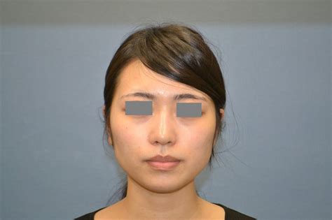 モニター写真集 美容外科・美容整形のサラ美容外科愛知県・名古屋【脂肪吸引、豊胸、二重、レーザー脱毛、プチ整形、若返り】