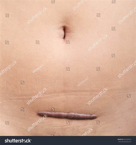 Hysterectomy Scar
