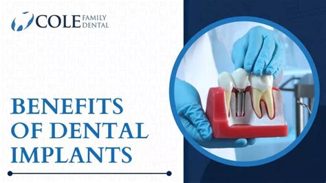 Ppt Benefits Of Dental Implants Powerpoint Presentation Free