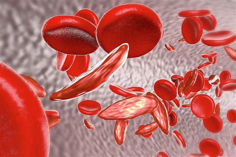 Sickle Cell Anaemia Photograph By Kateryna Kon Science Photo Library