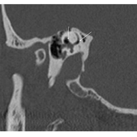 (PDF) Perilymphatic Fistula: A Review of Classification, Etiology ...