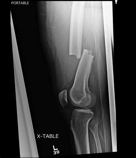 If Im Going To Break My Femur I Guess I Should Do It All The Way R