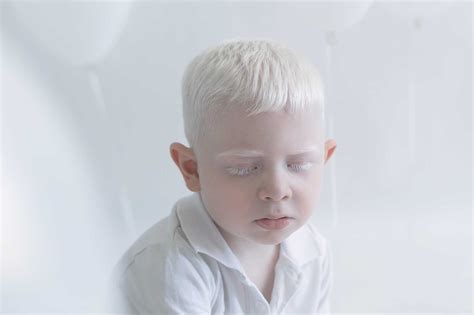 Albino
