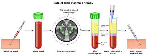 Platelet Rich Plasma Treatment How Does It Work Biobase