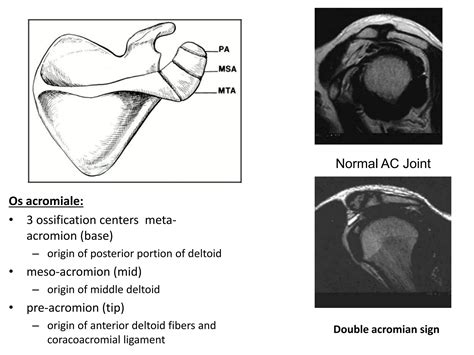 Mri Shoulder Joint With Common Pathologies Ppt