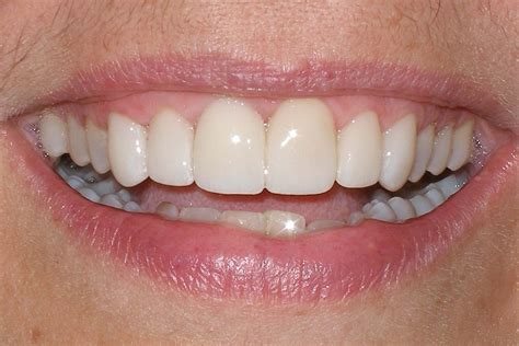 Veneers Smile Gallery - Raber Dental, Kidron Dentist