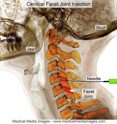 Cervical Spine Arthritis X Ray Teachmens
