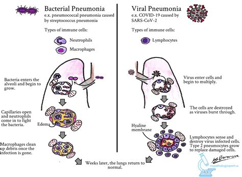 Pneumonia Mypathologyreportca