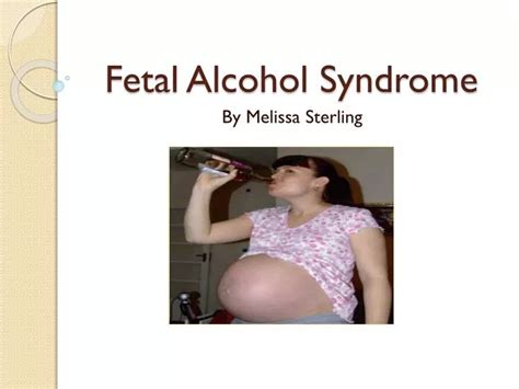 Ppt Fetal Alcohol Syndrome Powerpoint Presentation Free Download Id 2150106