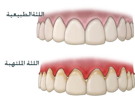 التهاب اللثة أسبابه، وأعراضه، وأهم 4 طرق لعلاجه