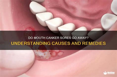 mouth canker sores   understanding   remedies medshun
