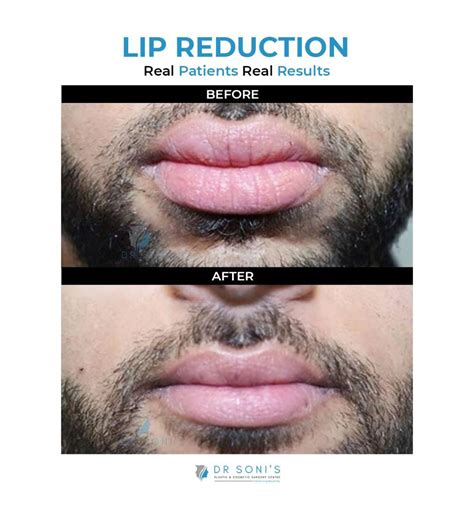 lip reduction surgery lip thinning surgery  panipat haryana