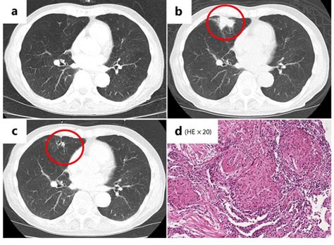 histological findings  granulomas  ct scan
