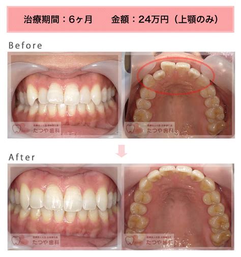 前歯1本だけを部分矯正で安く早く改善｜たつや歯科の症例紹介