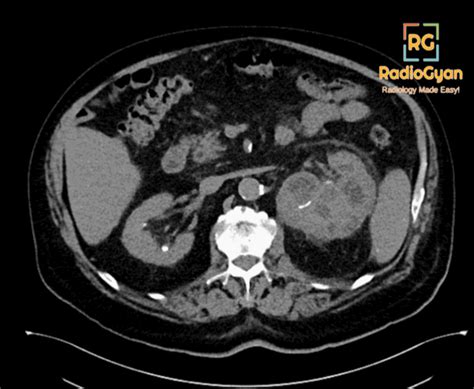 Xanthogranulomatous Pyeloneophritis Radiology Case Radiogyan